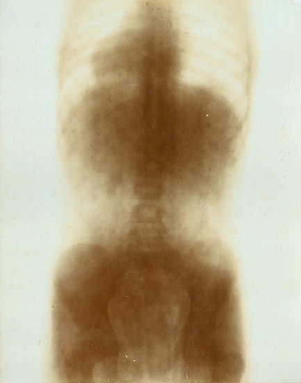 Prof. Contremoulin - Large X-ray of a Child's Torso